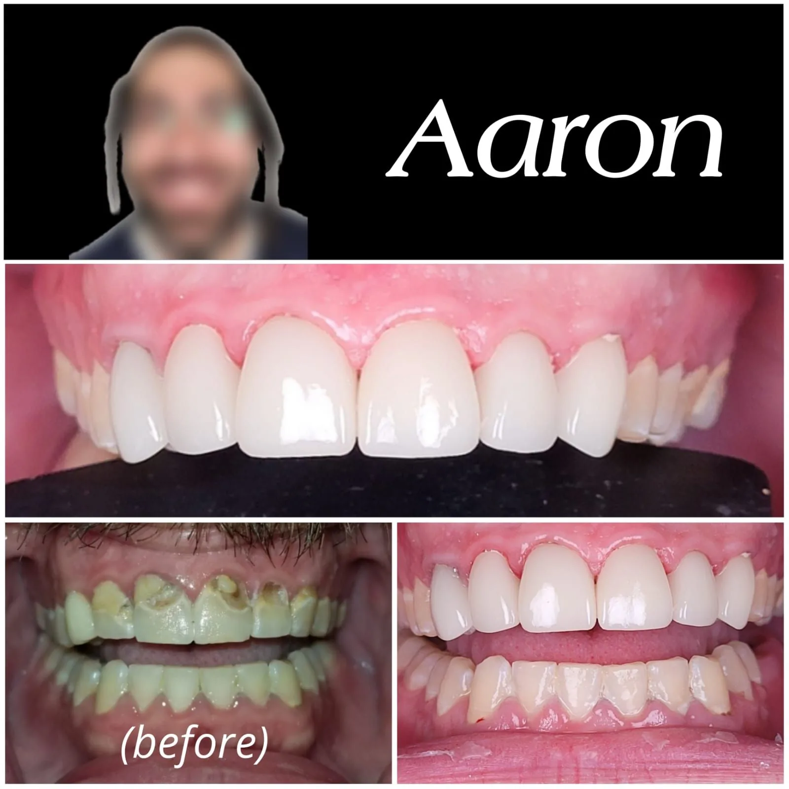 Smile transformation — Aaron