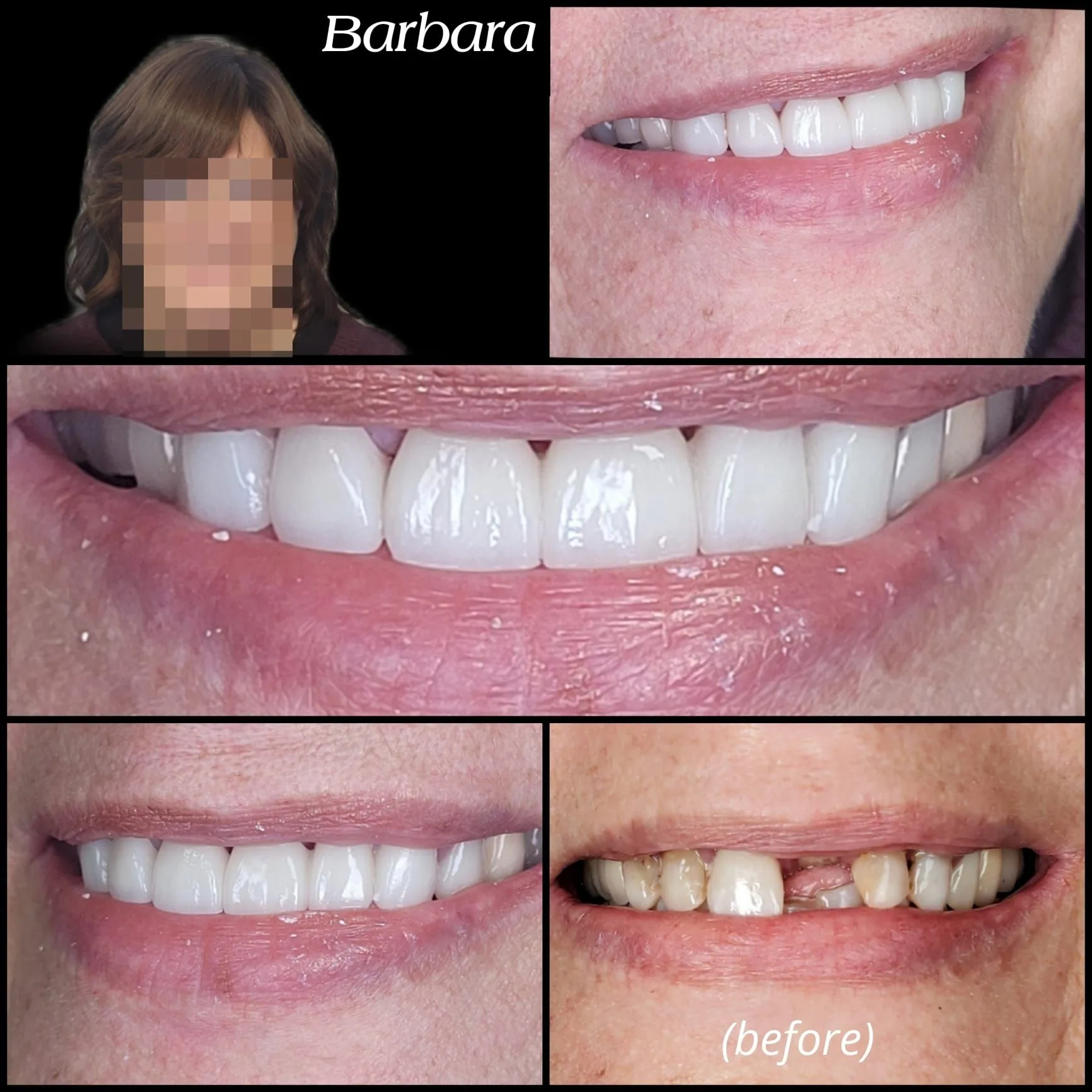 Smile transformation — Barbara