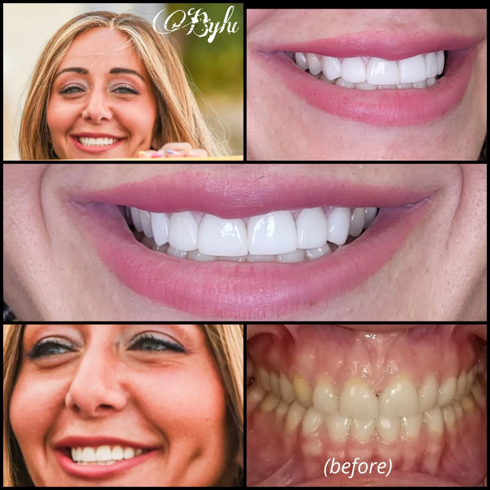 Smile transformation — Bella