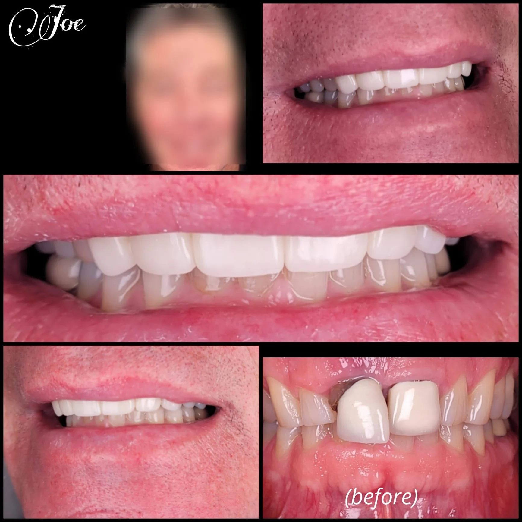 Smile transformation — Joe