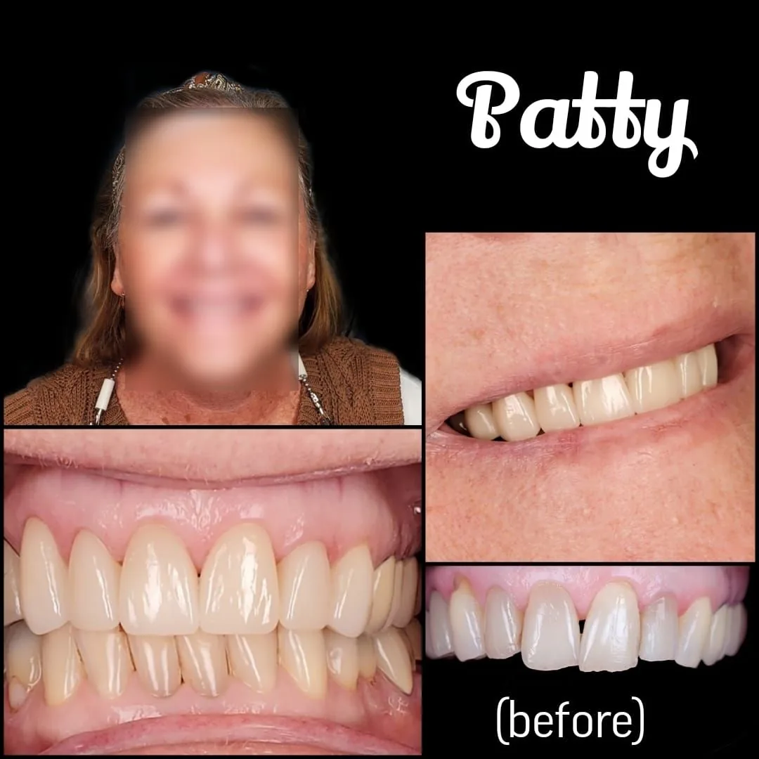Smile transformation — Patty