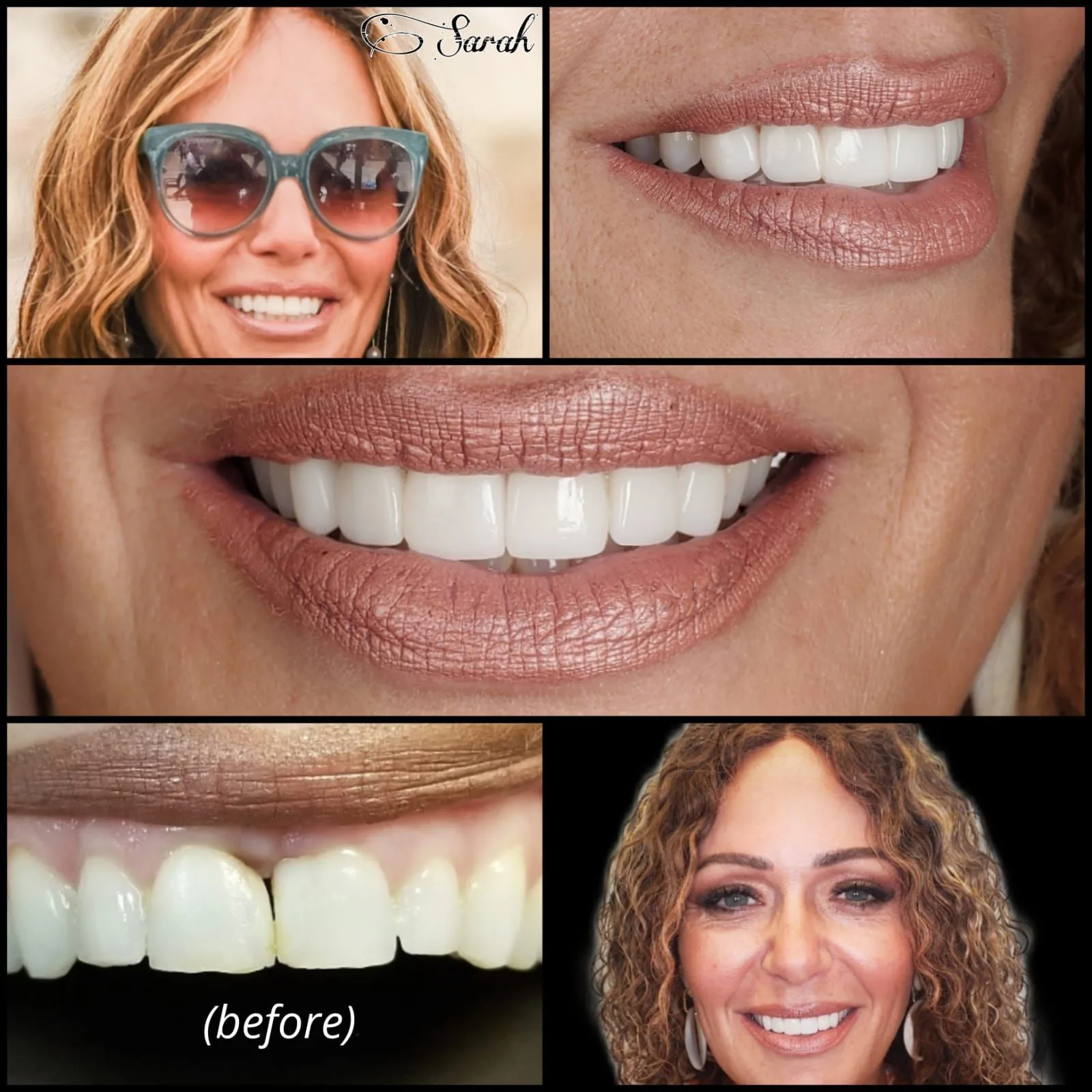 Smile transformation — Sarah